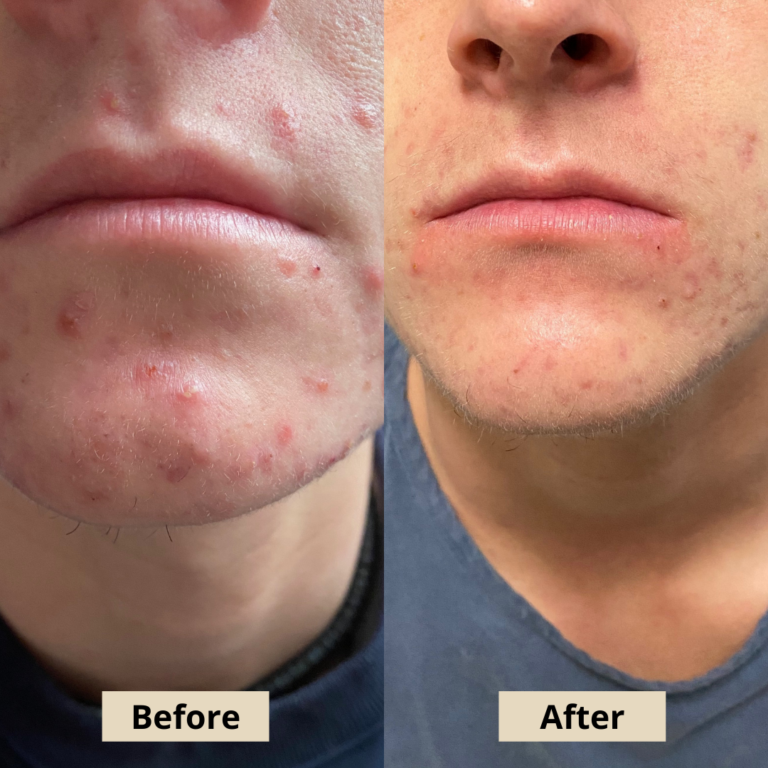 Grade 3 Acne System