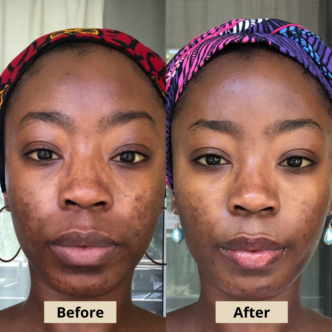 The Grade 2 Acne System that Shana prescribed me did not disappoint. The products helped control my acne, improve the appearance of my hyperpigmentation, and reduce uneven texture all over my face. -T. Manuel